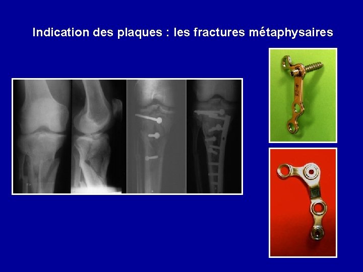 Indication des plaques : les fractures métaphysaires 