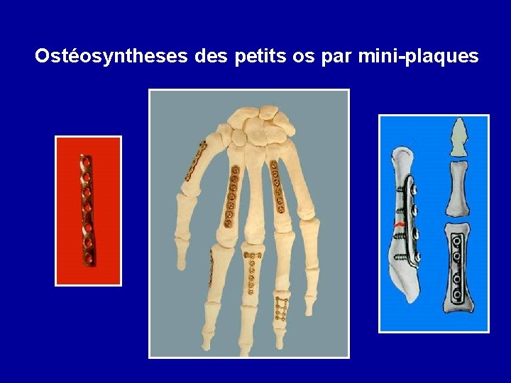 Ostéosyntheses des petits os par mini-plaques 