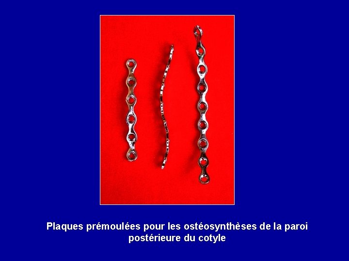 Plaques prémoulées pour les ostéosynthèses de la paroi postérieure du cotyle 