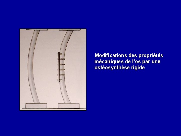 Modifications des propriétés mécaniques de l’os par une ostéosynthèse rigide 