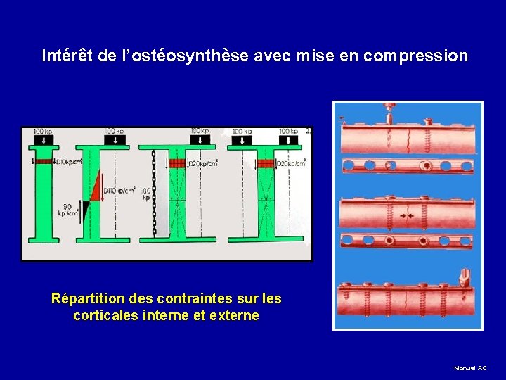 Intérêt de l’ostéosynthèse avec mise en compression Répartition des contraintes sur les corticales interne