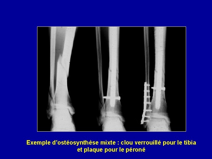 Exemple d’ostéosynthèse mixte : clou verrouillé pour le tibia et plaque pour le péroné