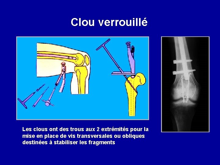 Clou verrouillé Les clous ont des trous aux 2 extrémités pour la mise en