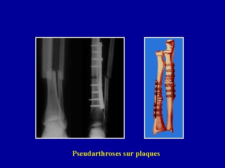 Pseudarthroses sur plaques 
