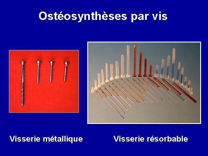 Ostéosynthèses par vis Visserie métallique Visserie résorbable 