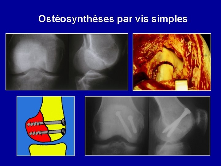 Ostéosynthèses par vis simples 