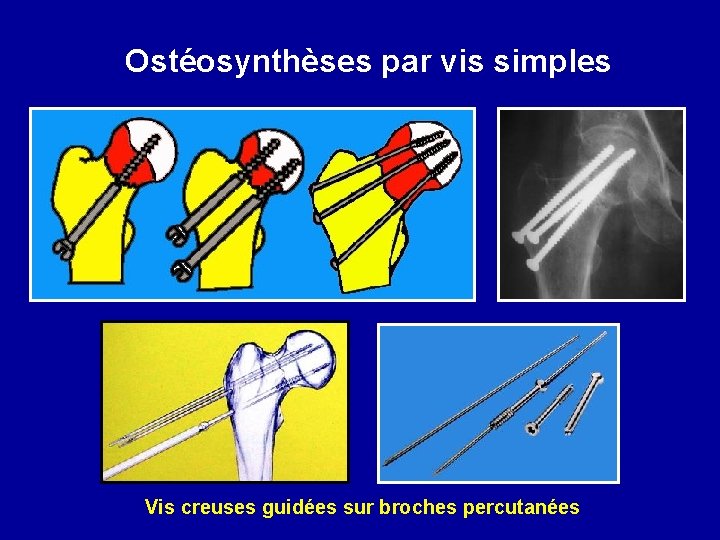 Ostéosynthèses par vis simples Vis creuses guidées sur broches percutanées 