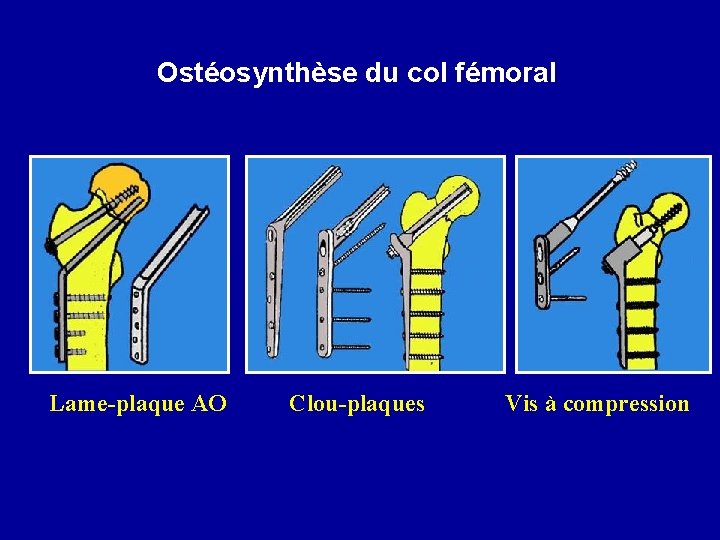 Ostéosynthèse du col fémoral Lame-plaque AO Clou-plaques Vis à compression 