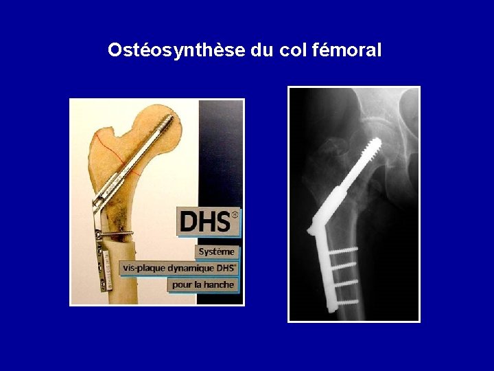 Ostéosynthèse du col fémoral 