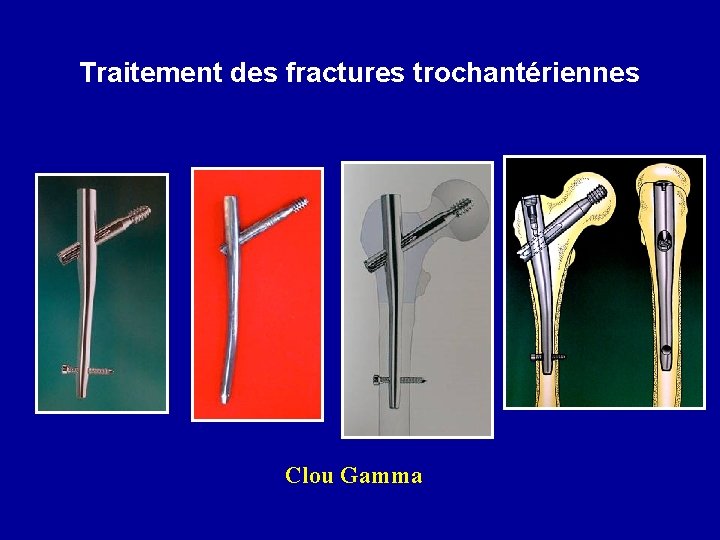 Traitement des fractures trochantériennes Clou Gamma 