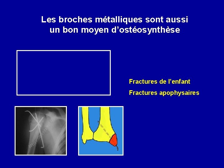 Les broches métalliques sont aussi un bon moyen d’ostéosynthèse Fractures de l’enfant Fractures apophysaires