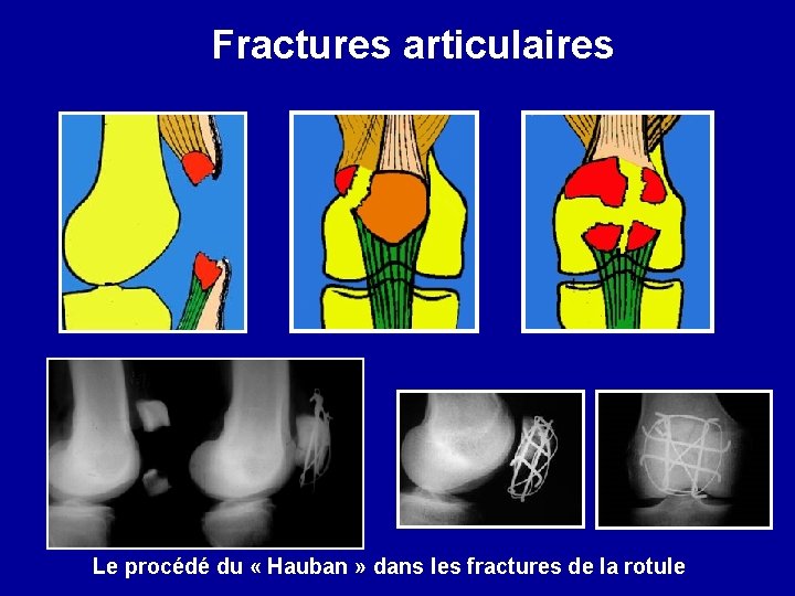 Fractures articulaires Le procédé du « Hauban » dans les fractures de la rotule