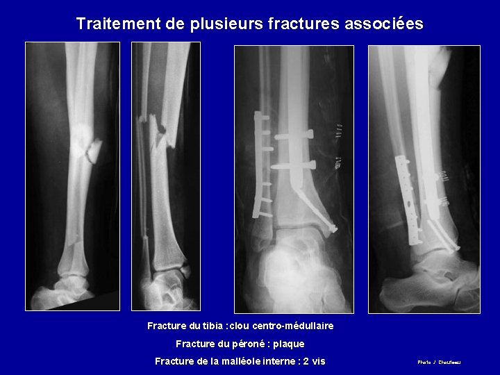 Traitement de plusieurs fractures associées Fracture du tibia : clou centro-médullaire Fracture du péroné