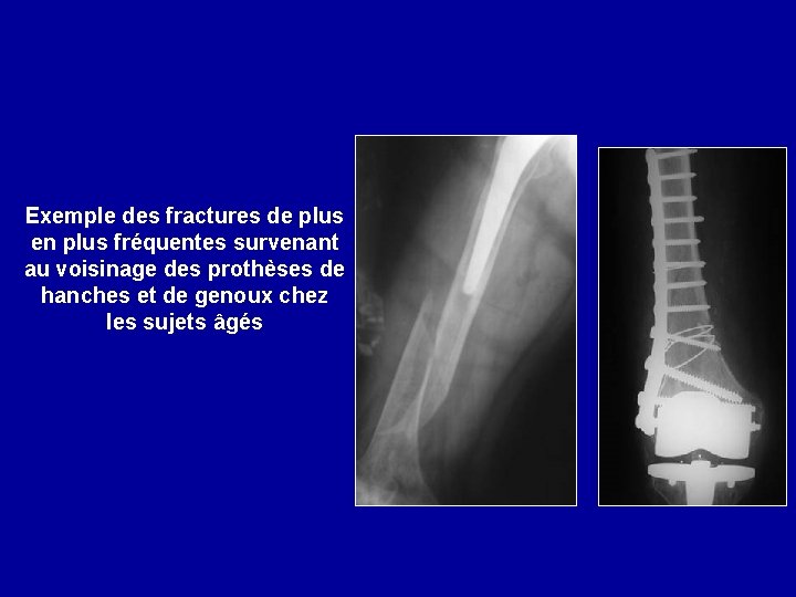 Exemple des fractures de plus en plus fréquentes survenant au voisinage des prothèses de