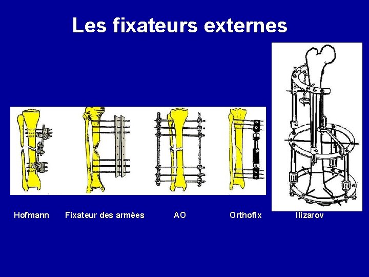 Les fixateurs externes Hofmann Fixateur des armées AO Orthofix Ilizarov 