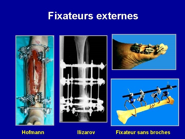 Fixateurs externes Hofmann Ilizarov Fixateur sans broches 