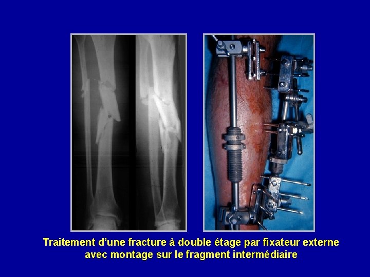 Traitement d’une fracture à double étage par fixateur externe avec montage sur le fragment