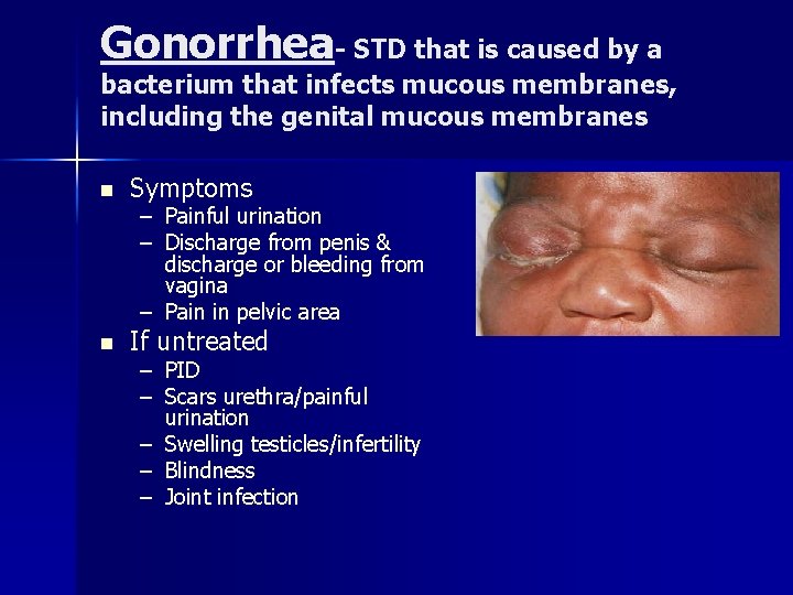 Gonorrhea- STD that is caused by a bacterium that infects mucous membranes, including the