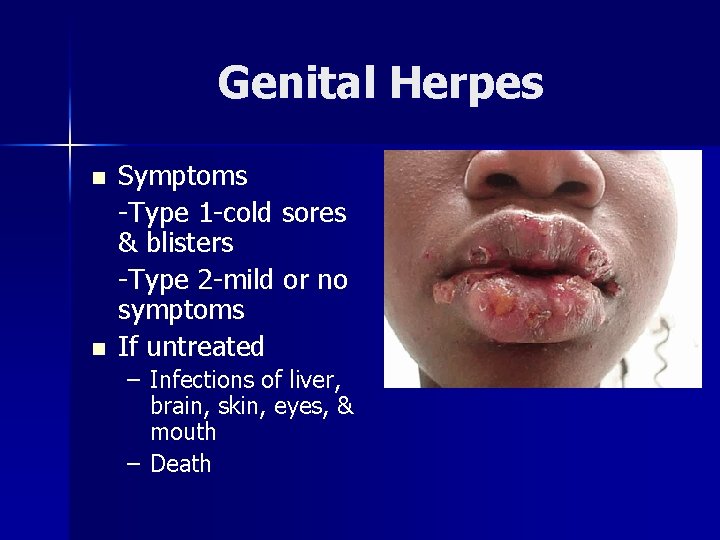 Genital Herpes n n Symptoms -Type 1 -cold sores & blisters -Type 2 -mild