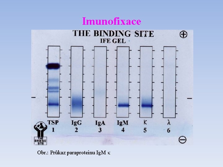 Imunofixace Obr. : Průkaz paraproteinu Ig. M k 