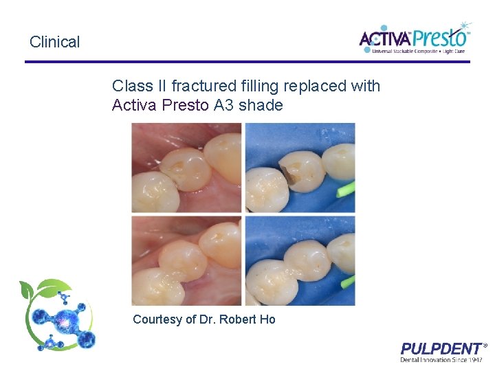 Clinical Class II fractured filling replaced with Activa Presto A 3 shade Courtesy of