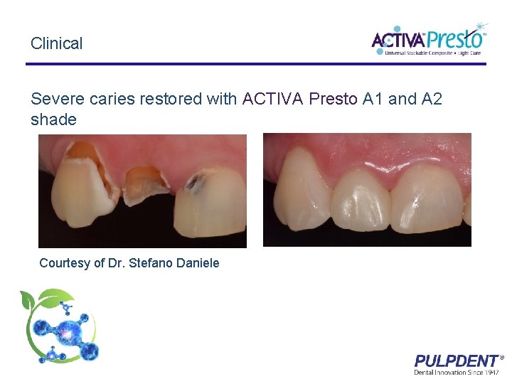 Clinical Severe caries restored with ACTIVA Presto A 1 and A 2 shade Courtesy