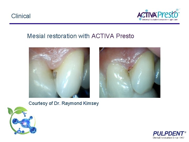 Clinical Mesial restoration with ACTIVA Presto Courtesy of Dr. Raymond Kimsey 