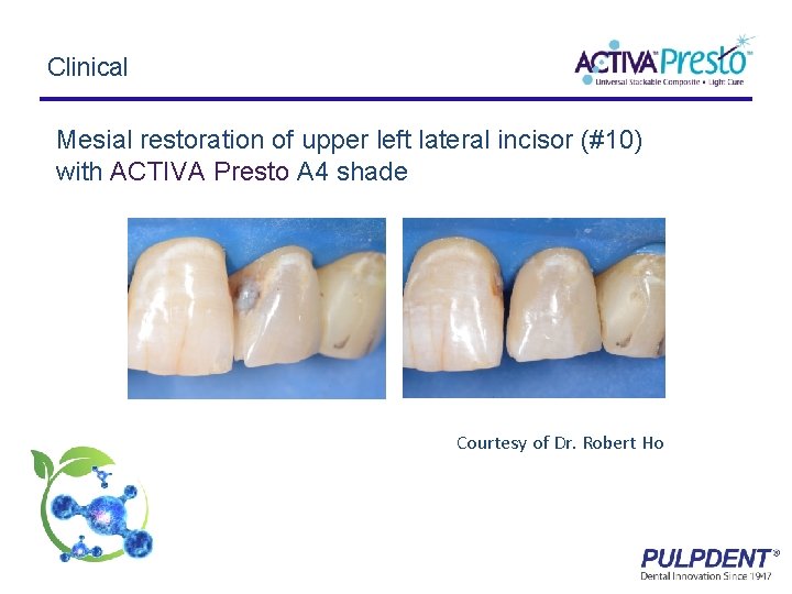 Clinical Mesial restoration of upper left lateral incisor (#10) with ACTIVA Presto A 4