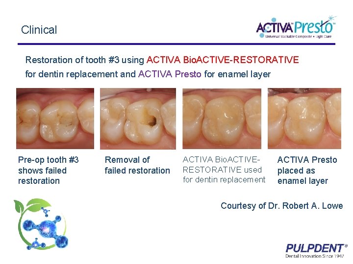 Clinical Restoration of tooth #3 using ACTIVA Bio. ACTIVE-RESTORATIVE for dentin replacement and ACTIVA