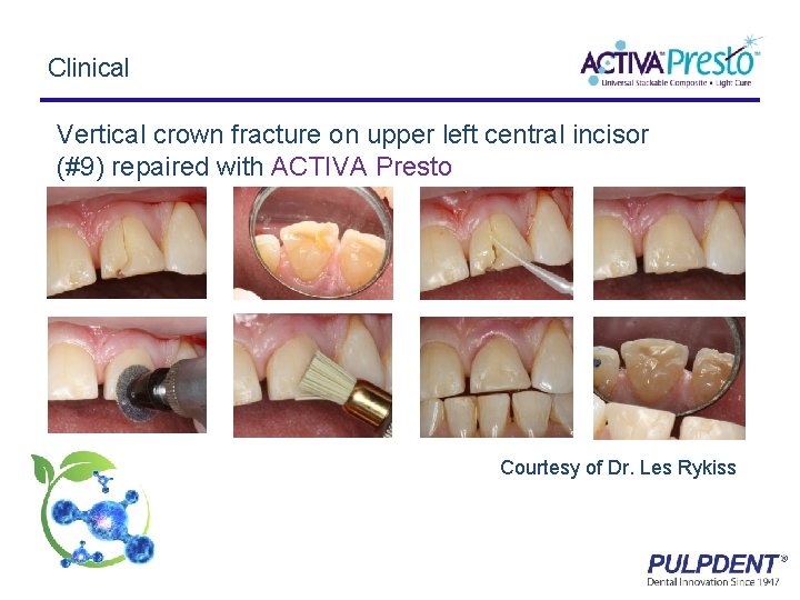 Clinical Vertical crown fracture on upper left central incisor (#9) repaired with ACTIVA Presto