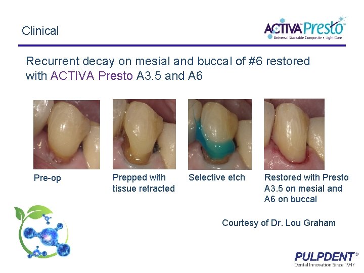 Clinical Recurrent decay on mesial and buccal of #6 restored with ACTIVA Presto A