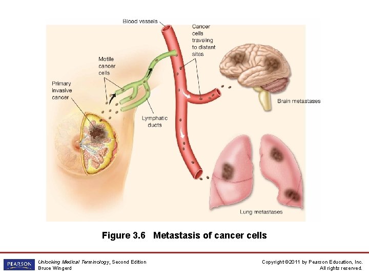 Figure 3. 6 Metastasis of cancer cells Unlocking Medical Terminology, Second Edition Bruce Wingerd