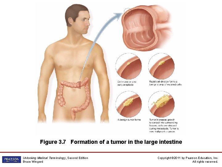 Figure 3. 7 Formation of a tumor in the large intestine Unlocking Medical Terminology,