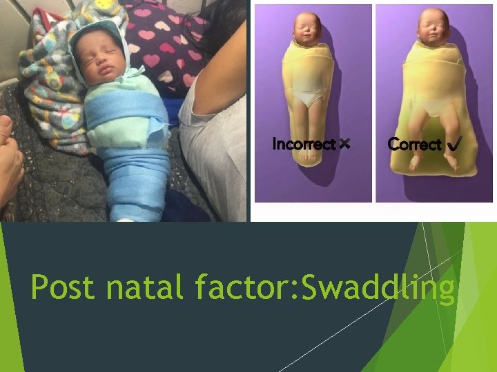 Post natal factor: Swaddling 