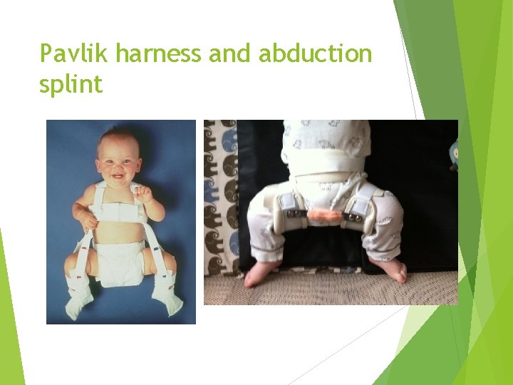 Pavlik harness and abduction splint 