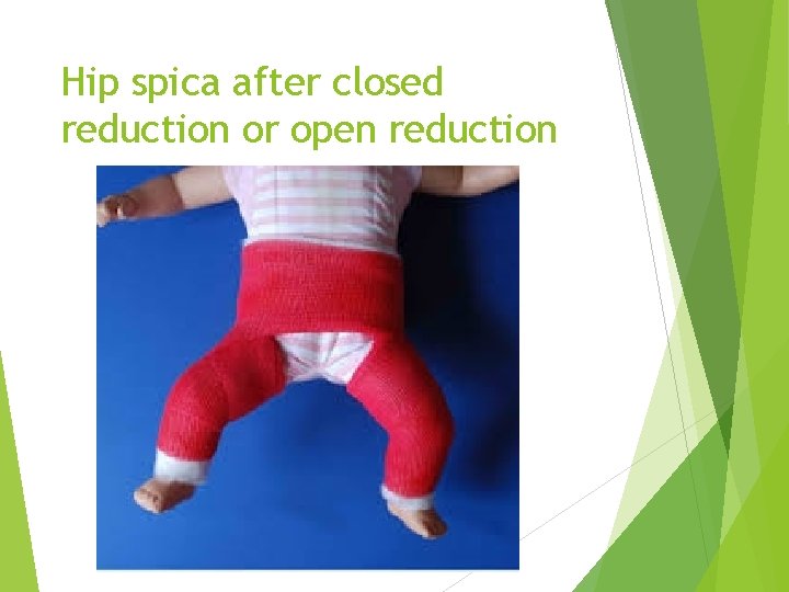 Hip spica after closed reduction or open reduction 