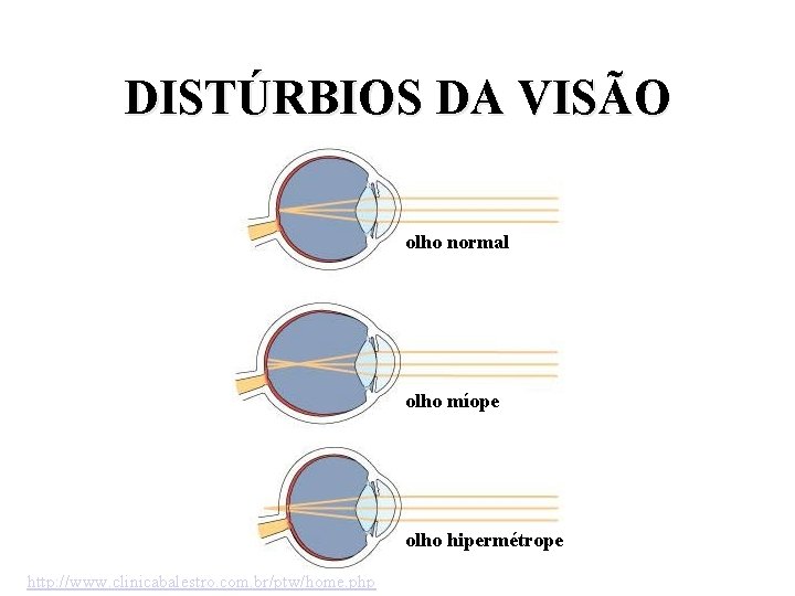 DISTÚRBIOS DA VISÃO olho normal olho míope olho hipermétrope http: //www. clinicabalestro. com. br/ptw/home.