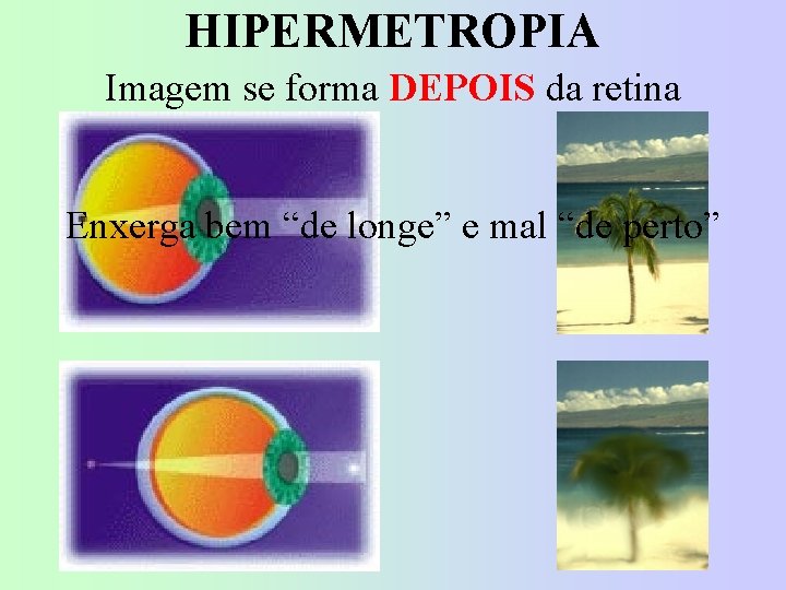 HIPERMETROPIA Imagem se forma DEPOIS da retina Enxerga bem “de longe” e mal “de