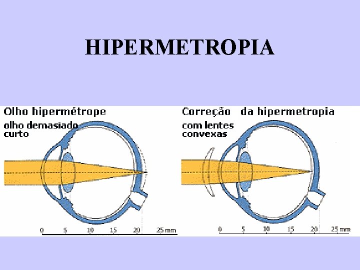 HIPERMETROPIA 