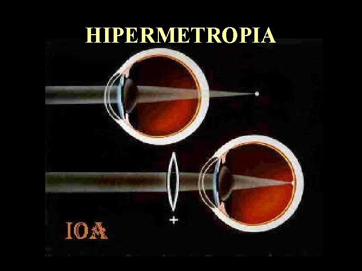 HIPERMETROPIA 