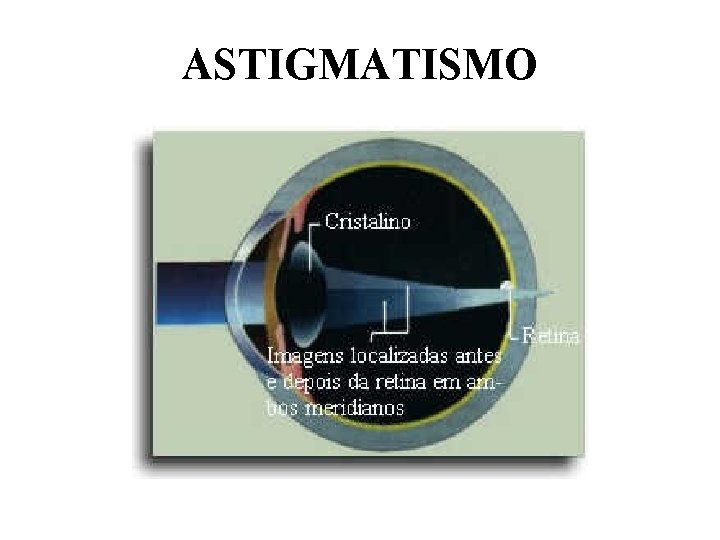 ASTIGMATISMO 