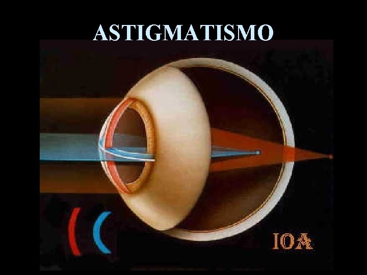 ASTIGMATISMO 