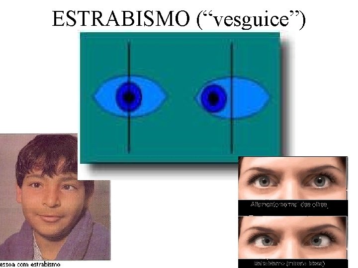 ESTRABISMO (“vesguice”) 