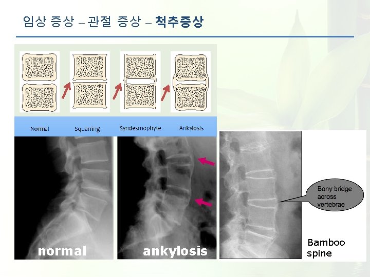 임상 증상 – 관절 증상 – 척추증상 normal ankylosis Bamboo spine 