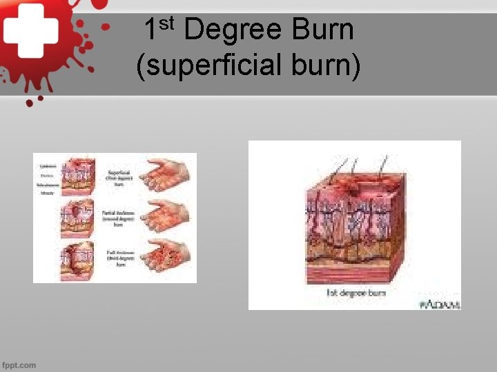 st 1 Degree Burn (superficial burn) 