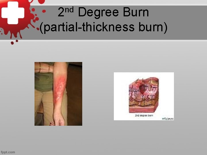 nd 2 Degree Burn (partial-thickness burn) 