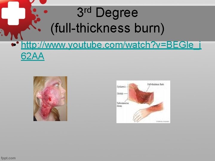 rd 3 Degree (full-thickness burn) • http: //www. youtube. com/watch? v=BEGle_j 62 AA 