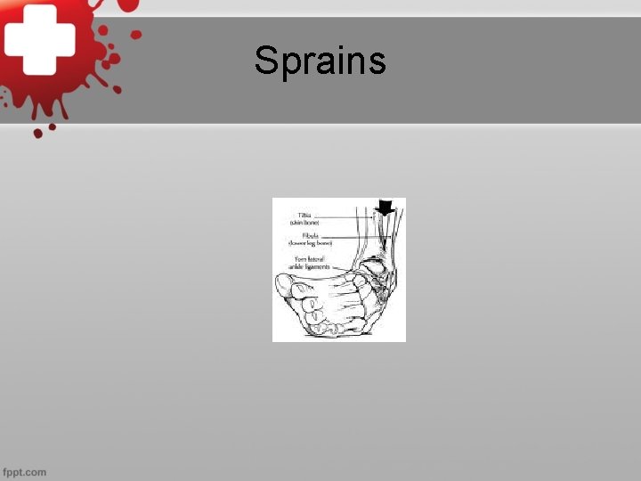 Sprains 