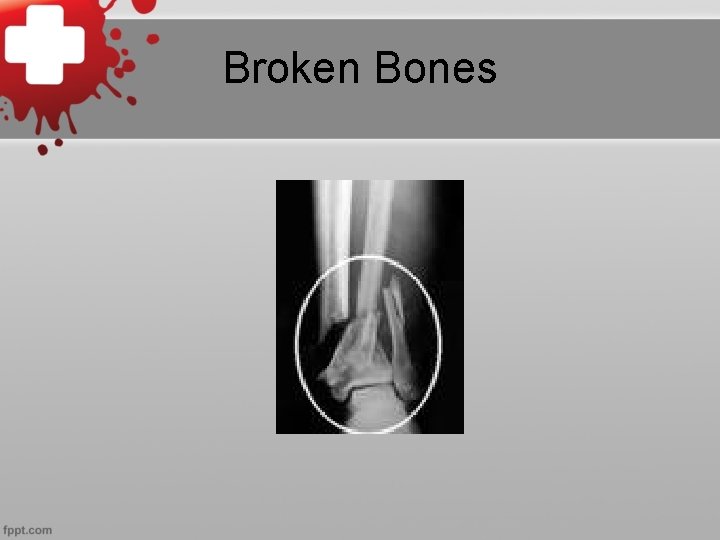 Broken Bones 