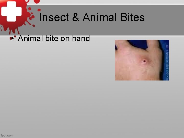 Insect & Animal Bites • Animal bite on hand 